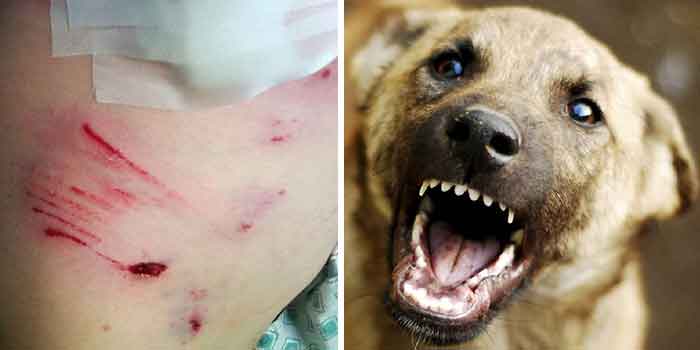 Что делать, если укусила собака: через несколько дней человека можно уже не спасти | DOCTORPITER